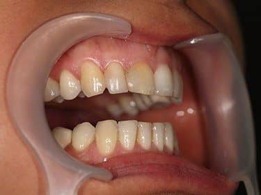 plombe vechi inestetice