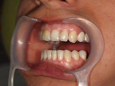 plombe vechi inestetice