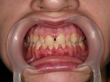 dinți nanici și malpozitionați