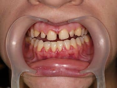 dinți preparați pentru fațetare și protezare