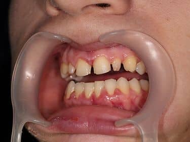 dinți preparați pentru fațete și coroane integral ceramice e-max