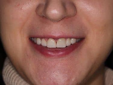 Fațete dentare și coroane integral ceramice e-max - Zâmbet frumos