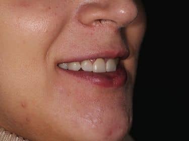 Fațete dentare și coroane integral ceramice e-max