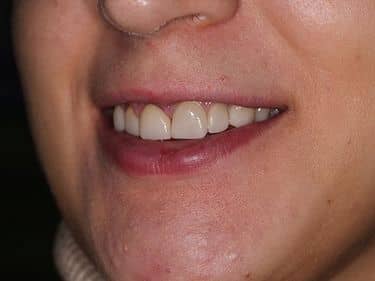 Fațete dentare și coroane integral ceramice e-max