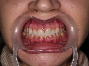 Fațete dentare și coroane integral ceramice e-max