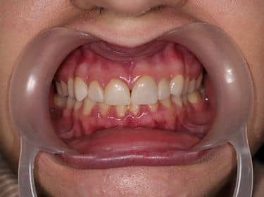 Fațete dentare și coroane integral ceramice e-max