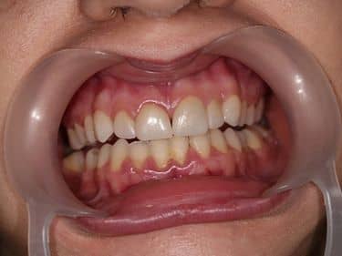 Fațete dentare și coroane integral ceramice e-max