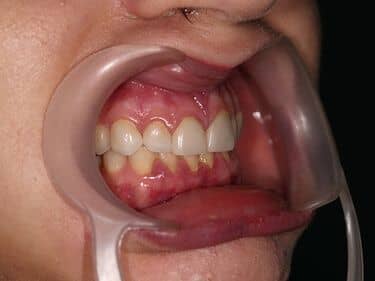 Fațete dentare și coroane integral ceramice e-max