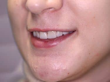 Fațete dentare și coroane integral ceramice e-max