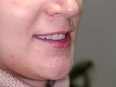 Fațete dentare și coroane integral ceramice e-max