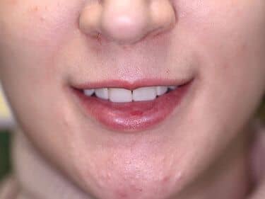 Fațete dentare și coroane integral ceramice e-max