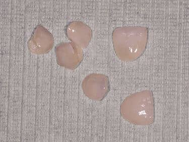 Fațete dentare și coroane integral ceramice e-max