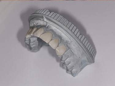 model fațete dentare