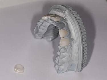 model fațete dentare