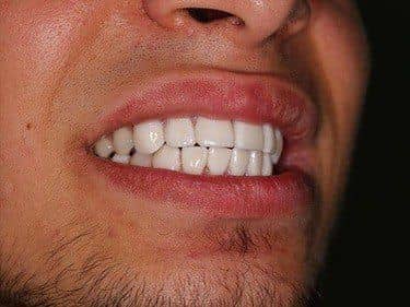 fațete dentare din porțelan