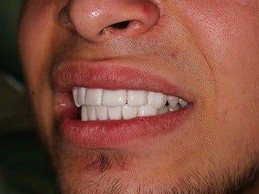 fațete dentare din porțelan