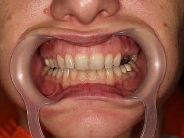 Dinți preparați pentru coroane