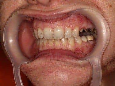 Dinți preparați pentru coroane