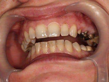 Dinți preparați pentru coroane