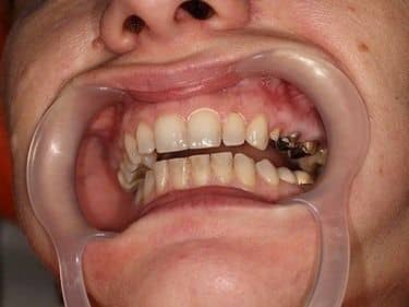 Dinți preparați pentru coroane