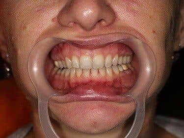 coronite din zirconiu