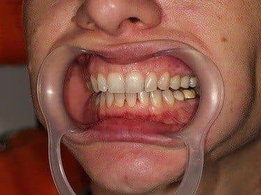 coronite din zirconiu