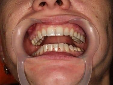 coronite din zirconiu