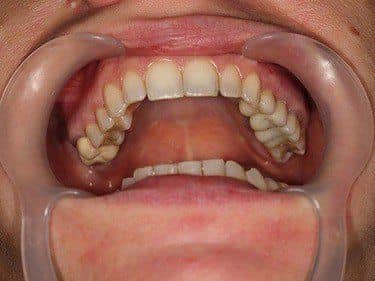 coronite din zirconiu