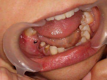 Implant dentar și dinți pregătiți pentru a fi îmbrăcați cu coroane