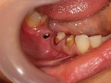 Implant dentar și dinți pregătiți pentru a fi îmbrăcați cu coroane