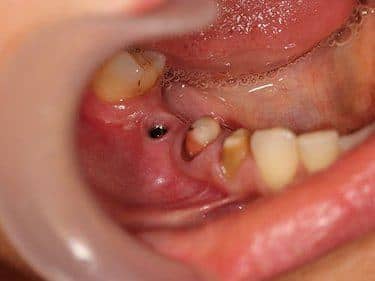 Implant dentar și dinți pregătiți pentru a fi îmbrăcați cu coroane