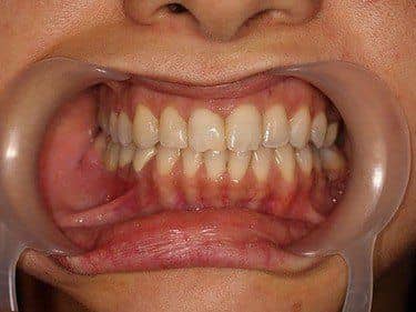 Coroane Dentare din Zirconiu