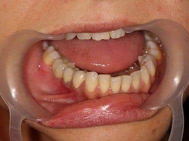 Coroane Dentare din Zirconiu