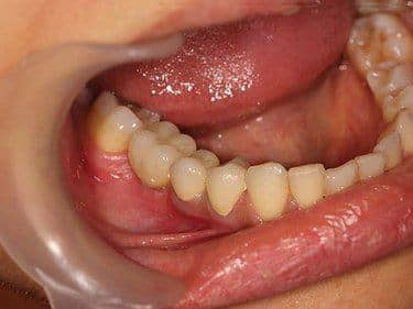 Coroane Dentare din Zirconiu