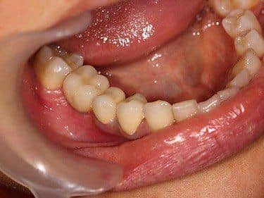 Coroane Dentare din Zirconiu