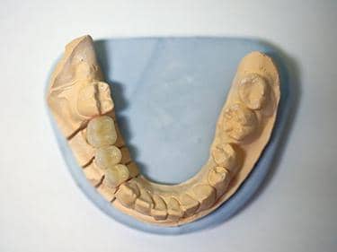 Coroane Dentare din Zirconiu