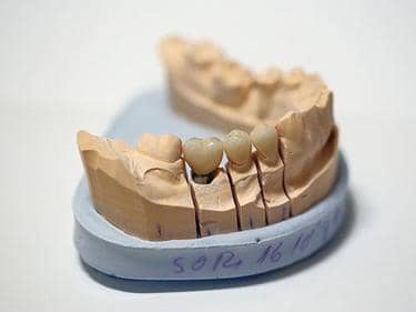 Coroane Dentare din Zirconiu