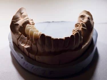 Coroane Dentare din Zirconiu