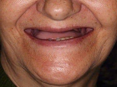 Edentație totală superioară și termino-terminală inferioară