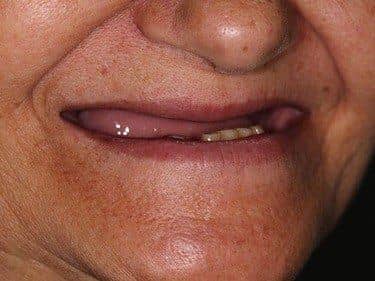 Edentație totală superioară și termino-terminală inferioară