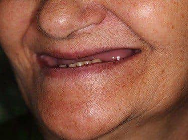 Edentație totală superioară și termino-terminală inferioară