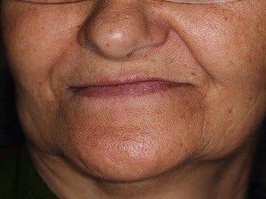 Edentație totală superioară și termino-terminală inferioară