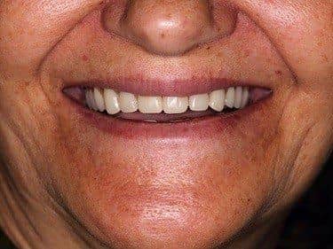 Edentație totală superioară și termino-terminală inferioară