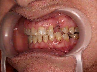 Edentație canin superior