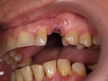 Edentație canin superior