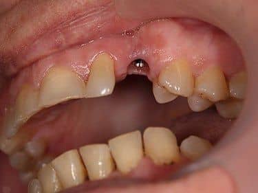 Edentație canin superior