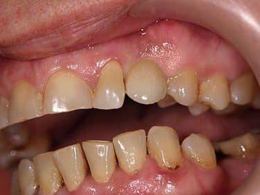 Implant dentar cu coroană metalo-ceramică