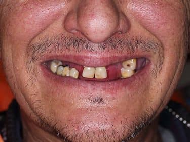 Edentație intercalată superioară și inferioară