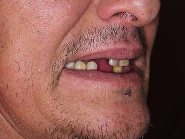 Edentație intercalată superioară și inferioară