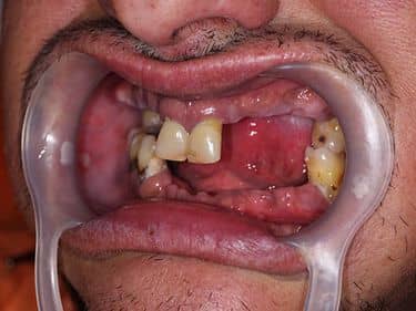 Edentație intercalată superioară și inferioară